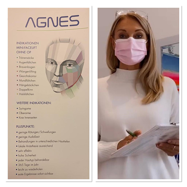 agnesbehandlung-augenfacelift